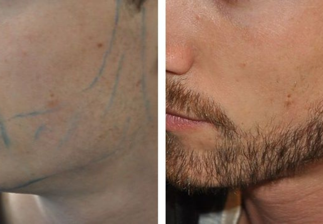 Beard Transplant: Everything You Need to Know for Fuller, Thicker Facial Hair