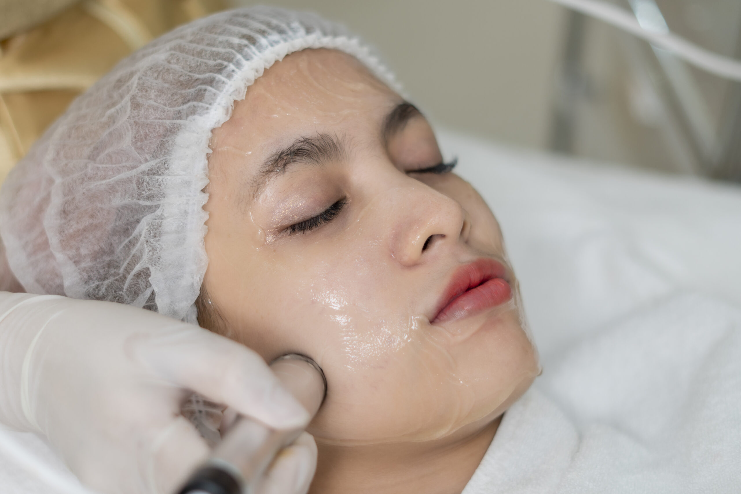 Glycolic Peel Treatment in Varanasi