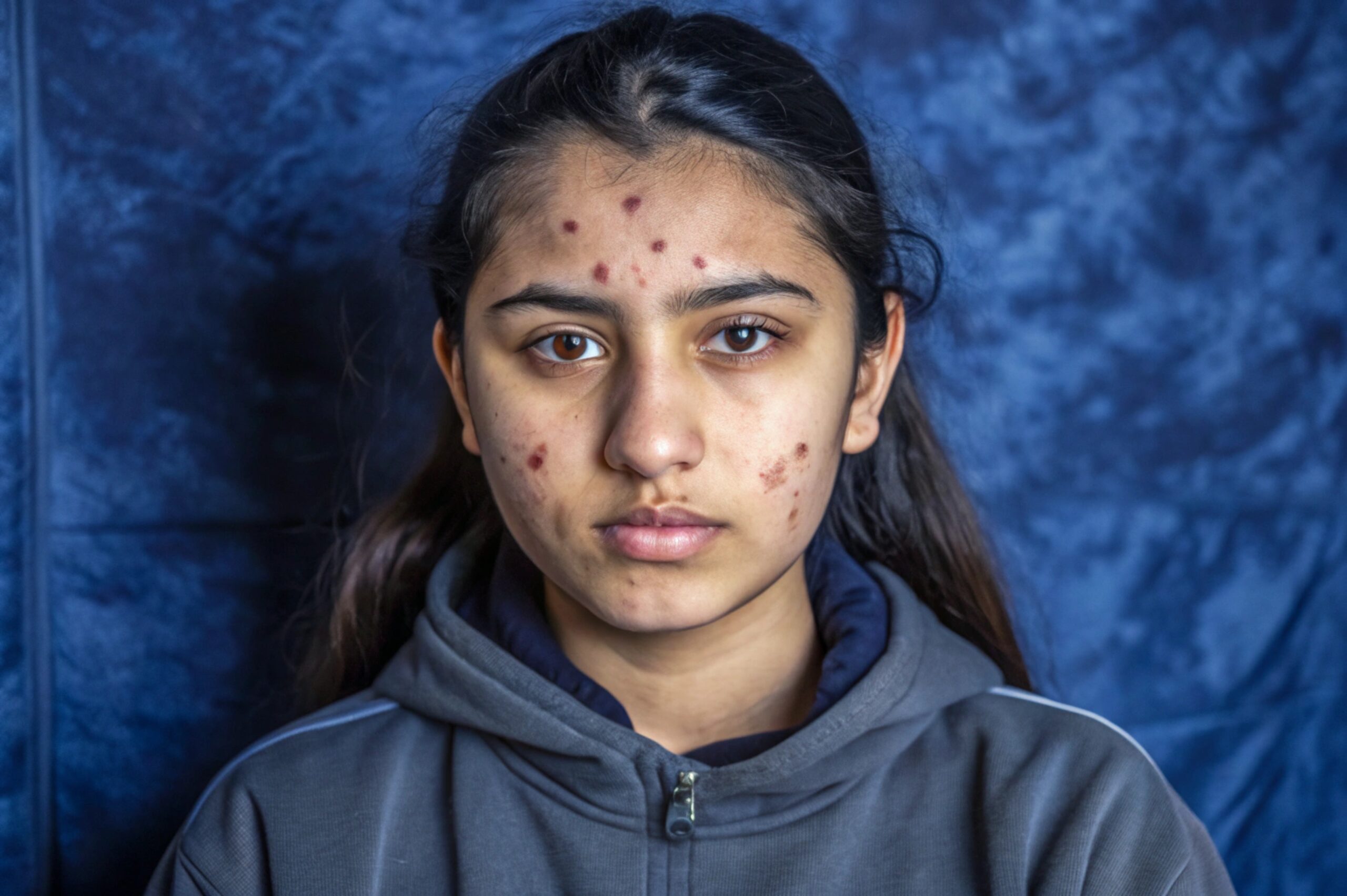 Are Acne Scars Permanent? – Top Dermat in Varanasi