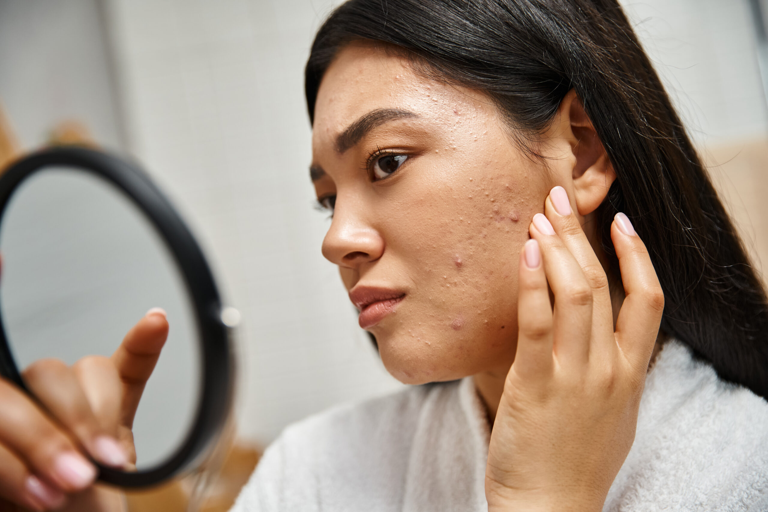 Are Acne Scars Permanent? – Top Dermat in Varanasi