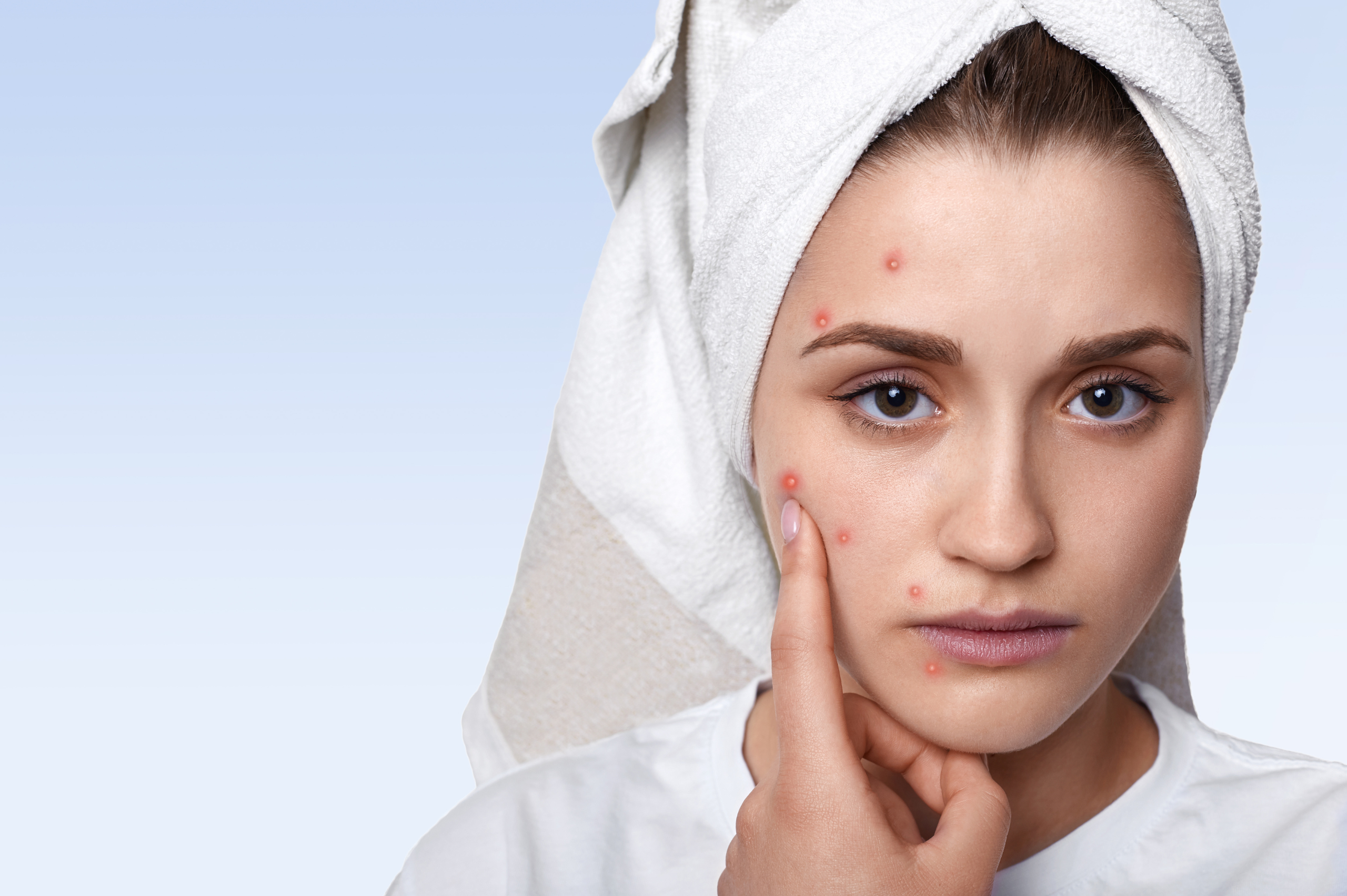 Hormonal Pimples Treatment in Varanasi – Causes, Diagnosis, Procedures