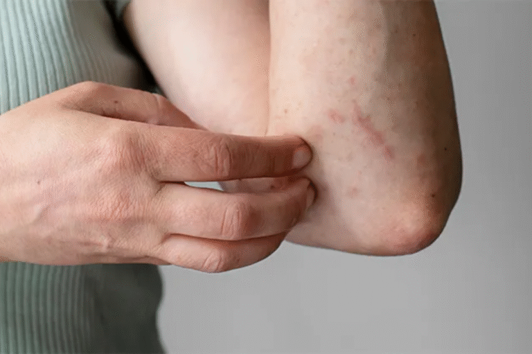 How Humidity Worsens Acne & Fungal Infections